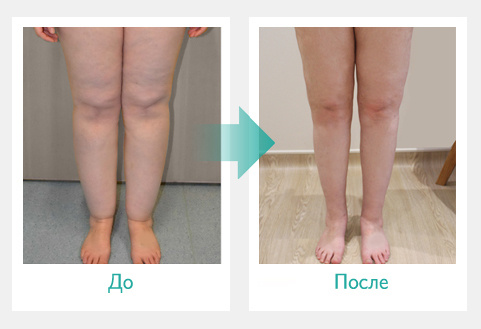 Аппарат прессотерапии Doctor life Mark 400 (Южная Корея) фото 6